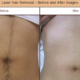 Diolaze XL before and after