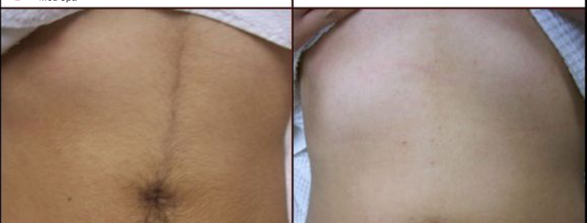 Diolaze XL before and after