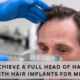 Hair Implants For Men